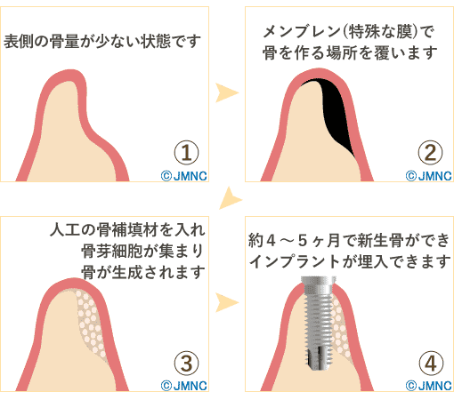 GBR（骨誘導再生法）