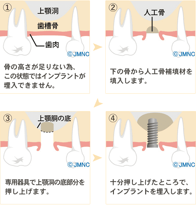 ソケットリフト法